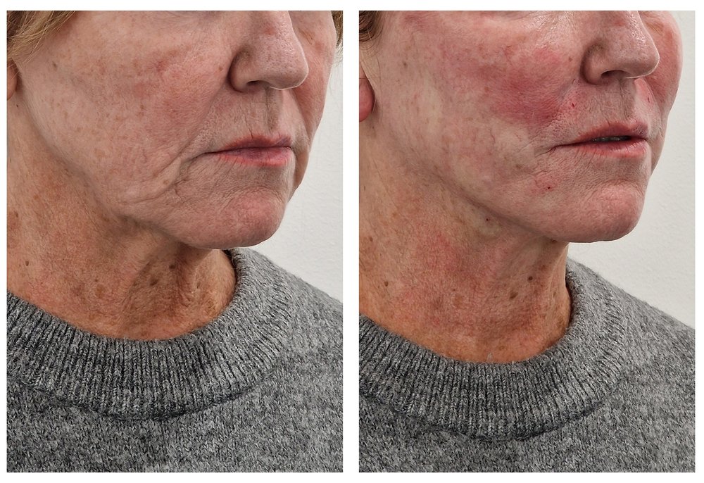 Q-Lift Ultimate before and after — jowl and neck lift