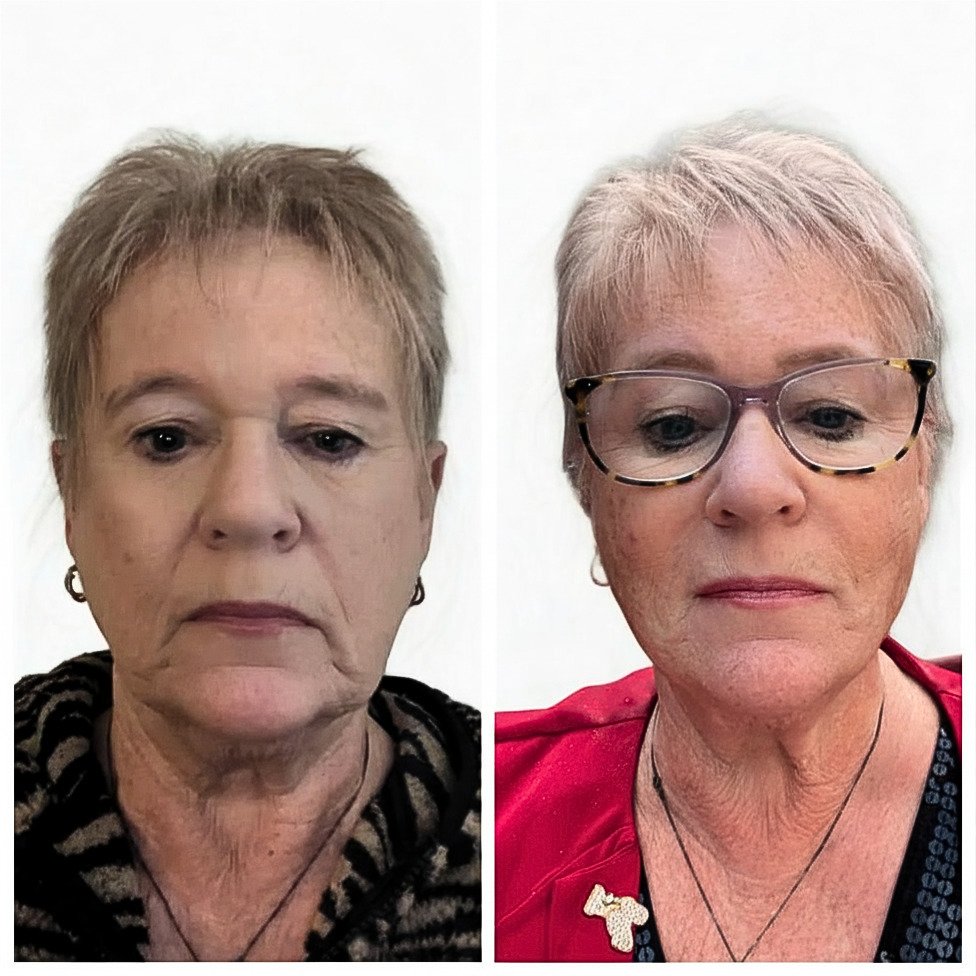 Q-Lift Ultimate before and after — full face and brow lift