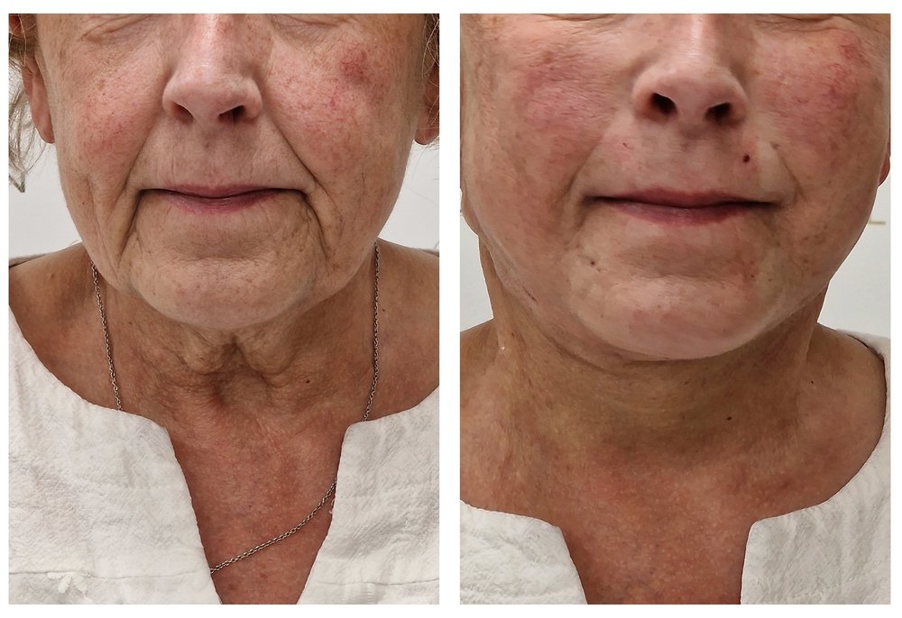 Q-Lift Ultimate before and after — neck rejuvenation