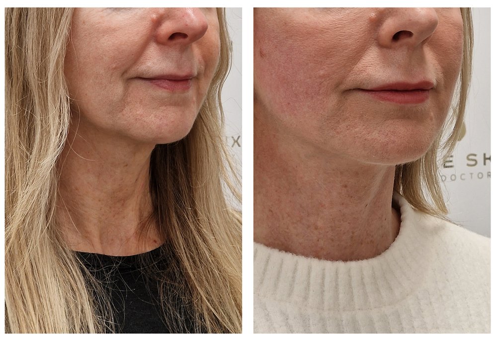Q-Lift Ultimate before and after — full facial lift