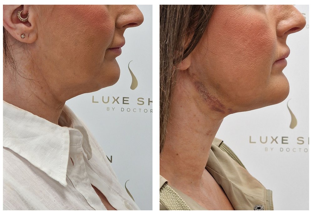Q-Lift Ultimate before and after — jawline definition