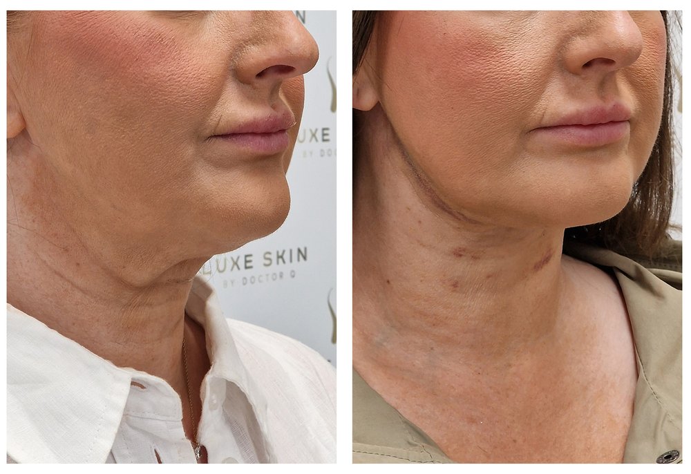 Q-Lift Ultimate before and after — jowl reduction