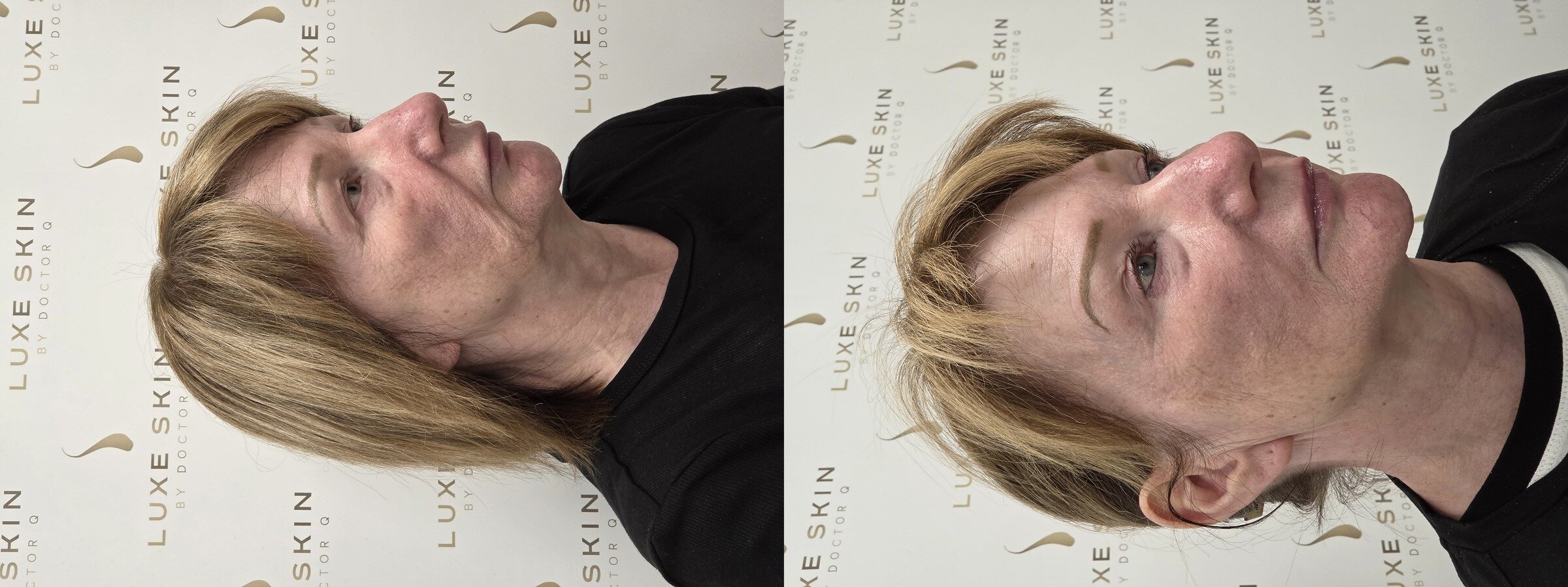 Betty before and after Q-Lift Ultimate, side profile